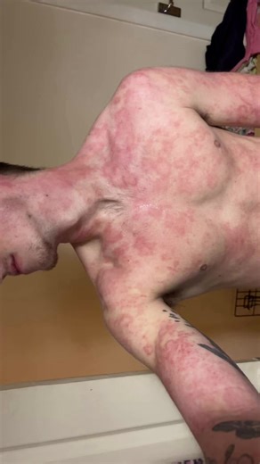 Understanding Eczema, Psoriasis, and Dry Skin