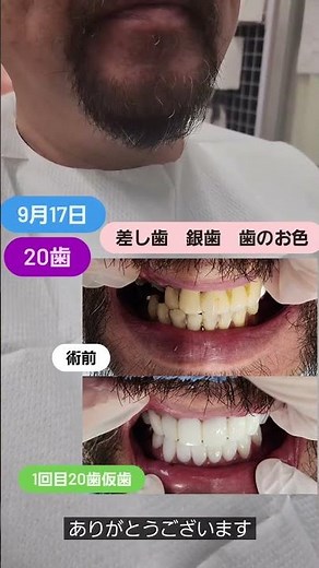 銀歯、差し歯、取れてしまった差し歯や奥歯の欠損など状態が芳しくない口腔内でした。被せ物は全て取り除き、中の虫歯、金属土台、根っこの再治療も含めて1回目に20齒仮歯まで進めていきました #セラミック