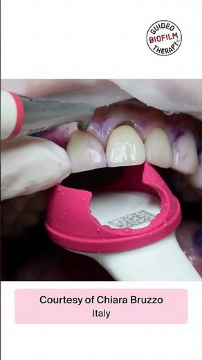 #Shorts - GBT treatment video on veneers featuring Chiara Bruzzo from Italy