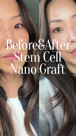caroline yu on Instagram: "In October of 2025 I went to Seoul and underwent a stem cell nano fat graft to my face and hands. Two different people from this beauty community recommended @idhospitalkorea for the work. They showed me their before and afters and were very happy with their results (one actually had a failed fat graft in the US with a VERY well known plastic surgeon). My doctor was Dr Ahn and I am super satisfied with results. Highly recommend Dr Ahn. I paid under $4k for the work and