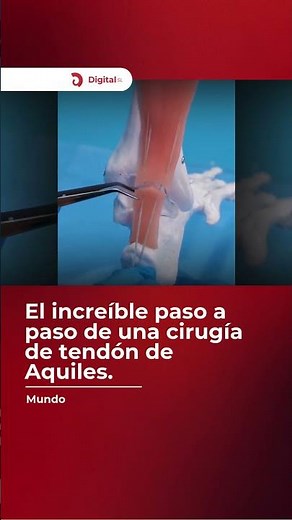 ¡Así se repara un cuerpo! 🦴💉 El increíble paso a paso de una cirugía de tendón de Aquiles. 🩺✨