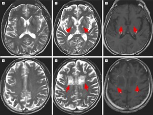 Adrenoleukodystrophy disease causes, symptoms, diagnosis, prognosis & treatment