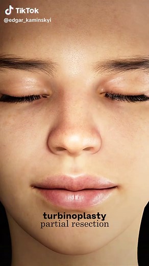 Understanding Inferior Nasal Turbinate Resection