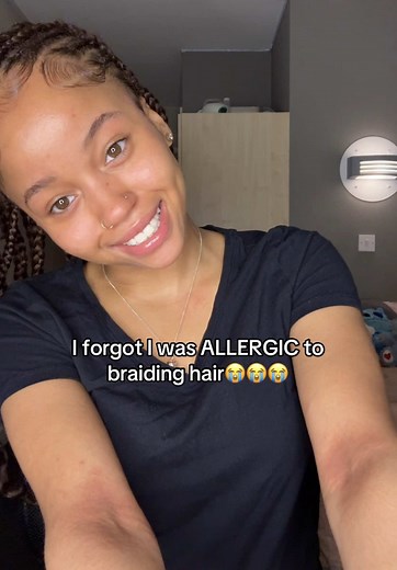 Allergic Reaction to Braiding Hair: My Experience