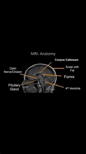 MRI Brain Anatomy