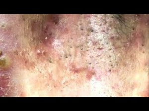 Cheeks Blackheads On The Face Easy | How To Remove Blackheads Easy