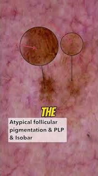 Dermoscopy deconstructed on this facial pigmented lesion.