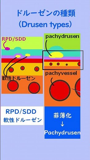 Key to Age-Related Macular Degeneration: The 3 Classifications of Drusen and Basic Pathophysiolog...