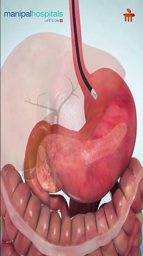 ERCP Procedure Explained | Dr. Pratap Bahera | MBO