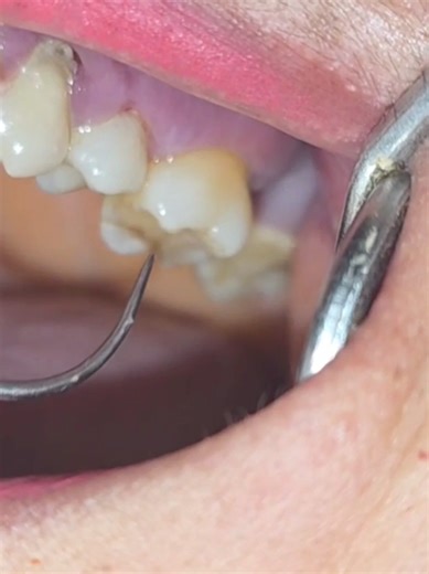 ¿Cómo lograr dientes más afilados y estéticos?