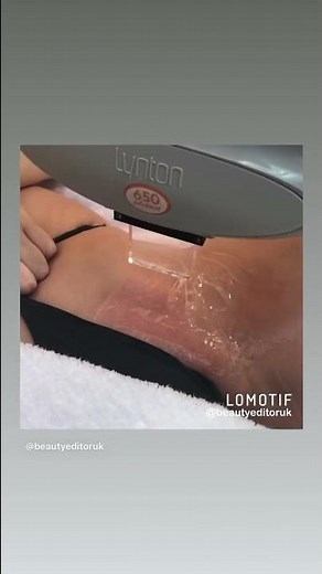 Brazilian Laser Hair Removal treatment in action