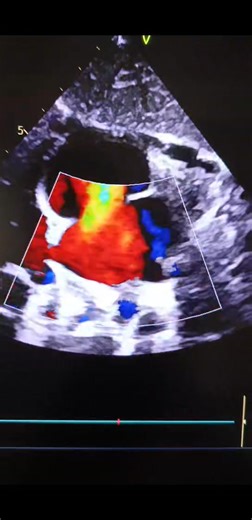 28K views · 165 reactions | #Short_case identify the shunt? a) Left to right shunt b) Right to left shunt c) Bi-directional shubt | echo and ecg club | Facebook