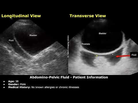 FAST Ultrasound Scan Reporting | Pericardial Effusion, Abdomino-Pelvic Fluid Case Reports Trauma USG
