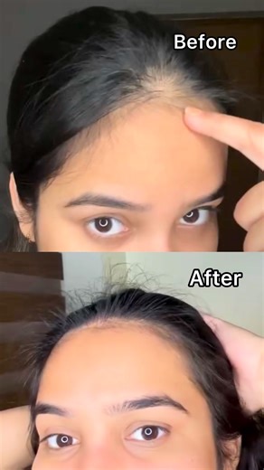 Hairfall stopping you? Not anymore. 💪 See visible results in just 28 days with Pilgrim’s Advanced Hair Growth Serum! Powered by Redensyl, Anagain, Korean Black Rice & Rosemary, it targets hairfall at the roots and boosts new growth naturally. 🌱 Visible results. Stronger, fuller hair. Shop Now and start your regrowth journey today! 🚀 | Pilgrim