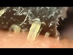 RETIRANDO ESPINHAS NO MICROSCÓPIO X1000 | Dr.ESPINHAS |