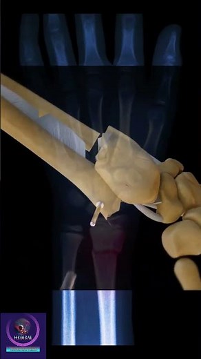 Wrist Fracture & Fixation # fracture #shorts