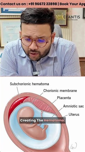 Subchorionic Hematoma: Bed Rest जरूरी है या नहीं? | Pregnancy Bleeding Care | Dr Mannan Gupta, Delhi