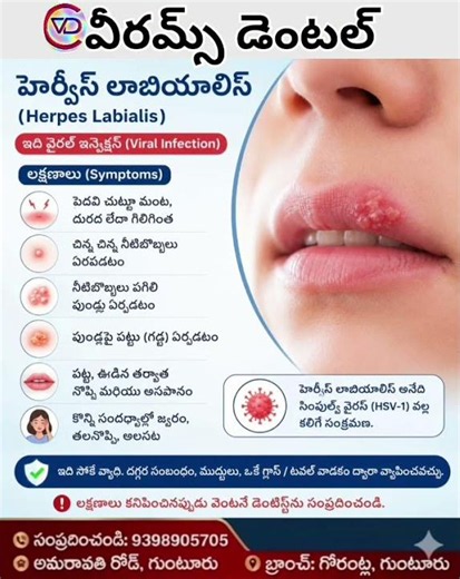 herpes labialis on upper lip