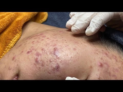 Blackhead & Whitehead Extraction on My P.2 #HoangMySpa165