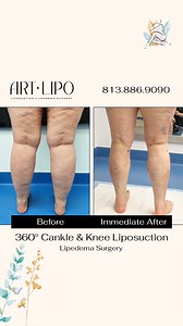 💕CANKLE & KNEE LIPOSUCTION IN ONE DAY💕 Ultra-Complete, High-Definition, Awake, Safe 360° #Liposuction of the Ankles, Calves (aka Cankles), and Knees performed by Liposuction and Lipedema Specialist Dr. Thomas Su 💪🏼 Slender, more shapely, and pain-free legs are possible! 💫 See Your Results Immediately! 💫 Minimal Downtime! Call us today 📞 1 (813) 886-9090 or visit ➡️ artlipo.com to schedule a complimentary consultation! FREE Virtual Consultations! 📲 Long Distance Consultations Available! �