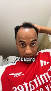 Brave the shave my balding brothers ! #fyp #balding #bald #glowup #recedinghairline