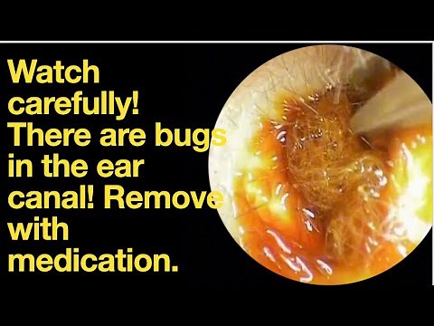 Watch carefully! There are bugs in the ear canal! Remove with medication.|ear wax removal |