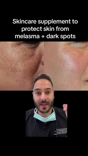 Protect Your Skin with the Best Melasma Supplement