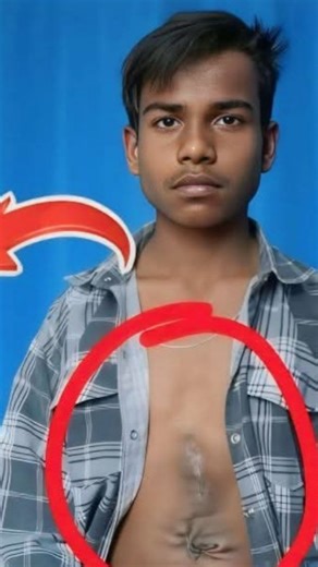 Nandini Sahay | the story of a 17-year-old boy from Uttar Pradesh, India, who was born with a rare condition where he had the extra lower limbs of an... | Instagram