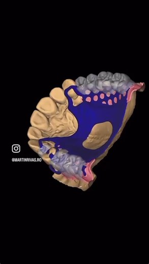 ¿Cómo se diseña una dentadura parcial moderna? | Rehabilitación Oral Digital