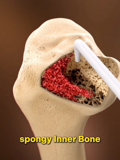 Partial Knee Resurfacing Surgery #kneepain #knee #kneesurgery #minimalinvasisekneesurgery #medicalanimation #kneeimplant #minimallyinvasivesurgery