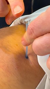 🏆 Dry needling is a powerful technique used to target tight, painful trigger points deep in the muscle tissue. By inserting fine needles directly into these irritated areas, we can help relieve tension, improve range of motion, and reduce pain. Whether it’s chronic stiffness, nerve entrapment, or post-workout soreness, dry needling gets to the root of the problem and promotes real healing. 💥 #DryNeedling #TriggerPointTherapy #PainRelief #SportsChiropractic #MuscleRecovery #ModernHealing | Dr_k