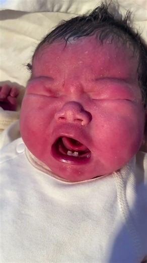 Causes of Natal Teeth:Genetic factors: This is one of the most common reasons #Newborn #nowbaby#cut