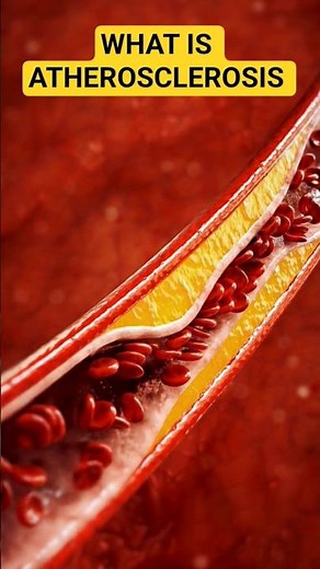 What is Atherosclerosis? 👀 | Explained in 60 Seconds #atherosclerosis #fat #cloggedarteries #biology