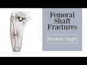 Femoral Shaft Fractures - broken thighbone (subtitled)
