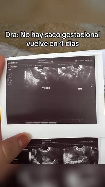 Entendiendo la ecografía del primer trimestre