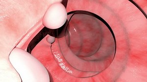 This 3d animation shows the intestinal polyps condition