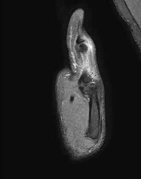 Extensor pollicis longus tendon tear