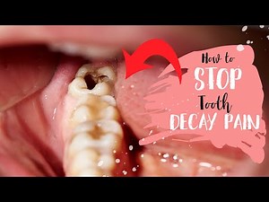 Best Home Remedies For Tooth Decay & Cavities🦷 tooth decay pain (Treatment for a Tooth Cavity)