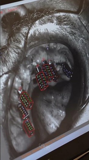 ✨Hybrid Prosthesis Scanning with iCam 4D | Advanced Full-Arch Implant Workflow✨ | Cinik Dental