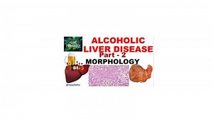 Alcoholic liver disease: Morphology, Clinical features & Complications - Pathology Made Simple