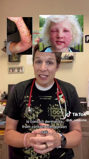 Immunity to Poison Oak in Pediatrics: Exploring Rash in Kids