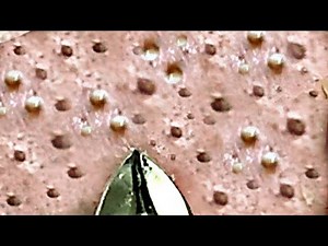 角栓 ブラックヘッド 角栓除去 ニキビ芯出し | ーニキビ #にきび治療 #BlackHeads #Whiteheads #Acnes #Dr_Somaria
