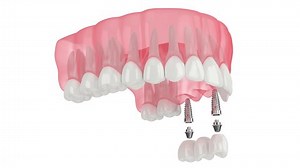 Upper Jaw Implants Supporting Dental Bridge Stock Footage Video (100% Royalty-free) 1075277840 | Shutterstock