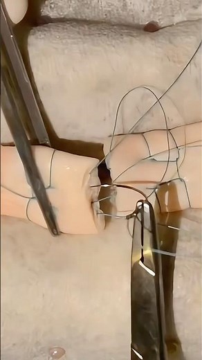 How Torn Tendons are Repaired: The Krackow Suture 😷 #goodtoknow #surgeonlife #suturing #lifehacks