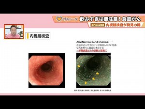 [Endoscopic examination is the key to detection] Be careful not to drink too much! Esophageal can...