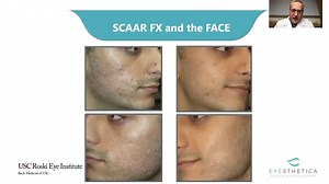 Laser Scar Treatment