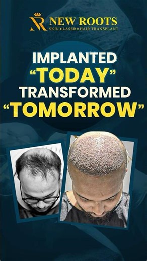 Hair Transplant Surgery Kolkata | Grade 5 Baldness Recovery & Results #hairtransplantsurgery #shorts