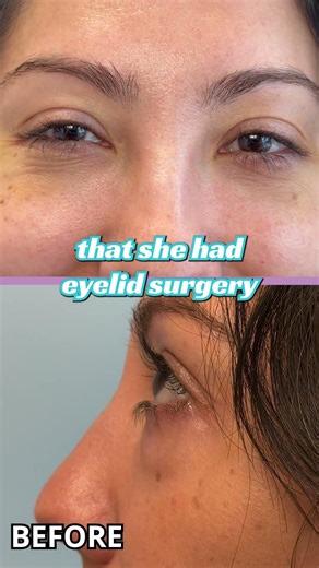 You can WEAR MAKEUP 1 WEEK after this surgery! #blepharoplasty