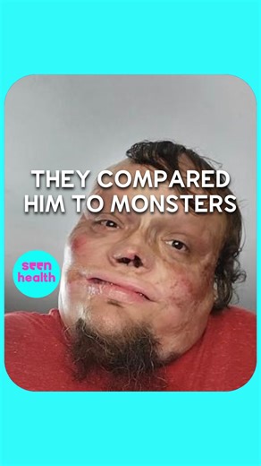2.7M views · 10K reactions | He Was Given A 1% Chance Of Survival He was given a 1% chance of survival after suffering severe third-degree burns as a child. Chris had over 200 surgeries by the time he was 13 year old and was bullied at school for looking different. He talks about the challenges he has faced and how romance has left him with emotional scars. Seen Health | seen.tv | Facebook