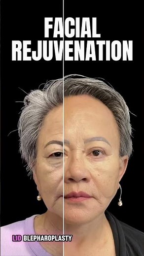 What Does a Deep Plane Facelift With Blepharoplasty Look Like? Before & After